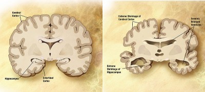 le petit journal des grandes découvertes,grandes découvertes,diabète,vih,alzheimer,vaccin vih 2013,informatique et science,fold it,mercure